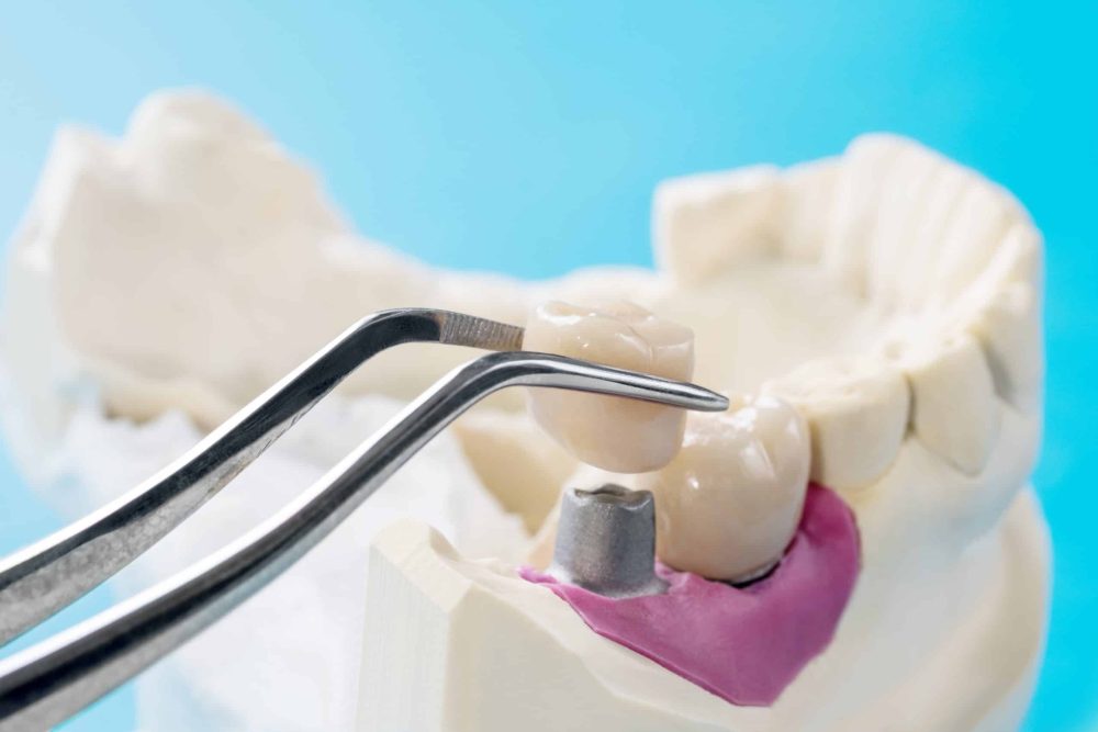 Prosthodontics Knoxville